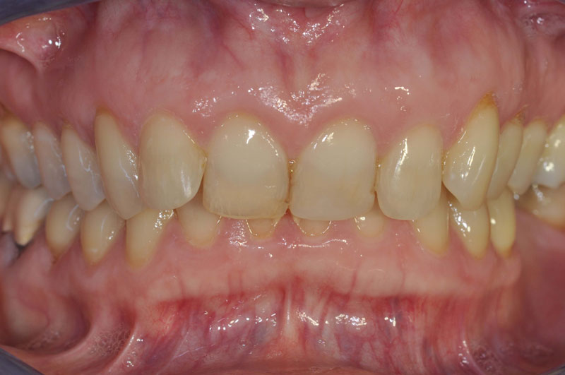 ortodonzia adulti